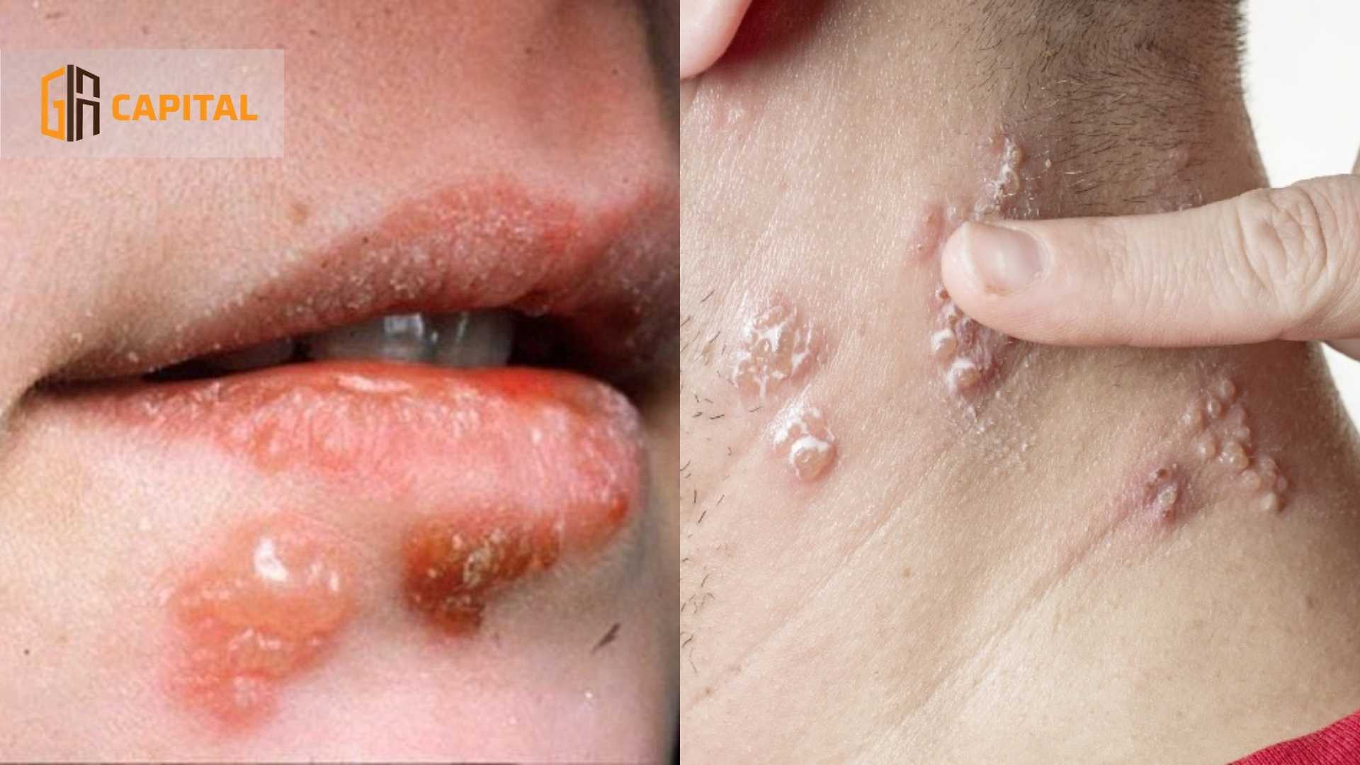 Bệnh lậu lây truyền qua đường tình dục