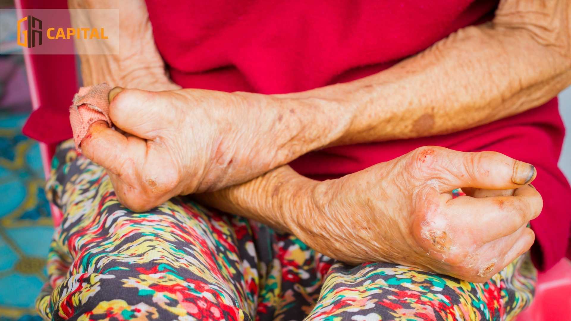 Bệnh phong rất nguy hiểm